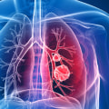 What part of the lungs does mesothelioma affect?