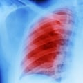 What causes mesothelioma other than asbestos?